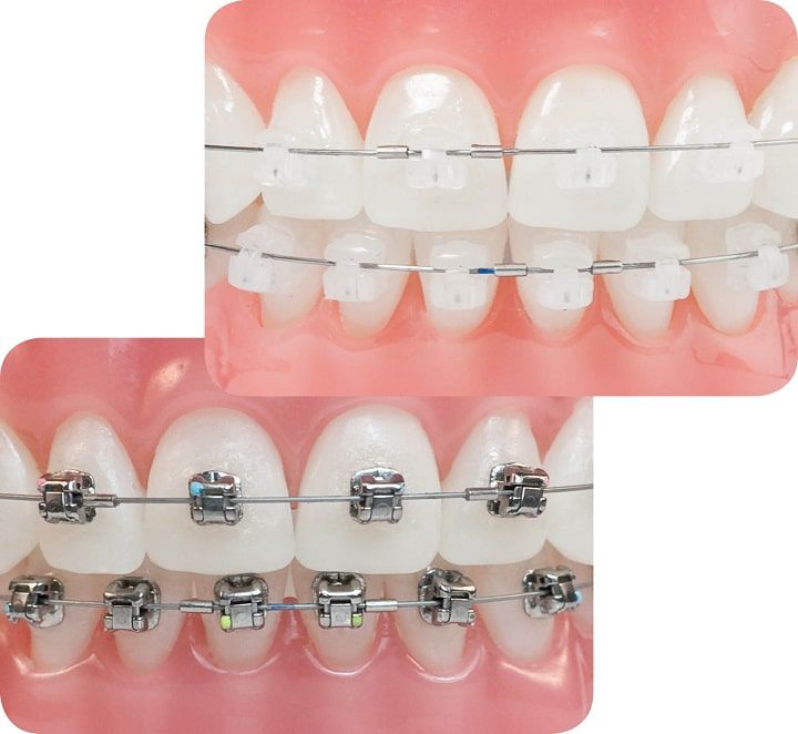 Sự khác nhau giữa niềng răng chỉnh nha và niềng răng thẩm mỹ - nhakhoahoanmyhcm.over-blog.com