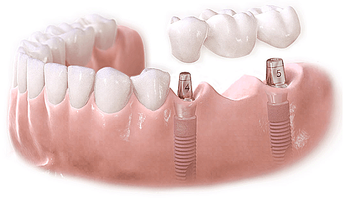 Địa chỉ cắm ghép răng ở đâu tốt ở TPHCM? – Nha Khoa Hoàn Mỹ
