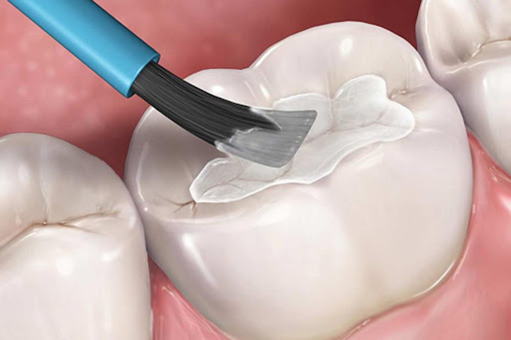 Những trường hợp có thể sử dụng phương pháp trám răng – Nha Khoa Hoàn Mỹ