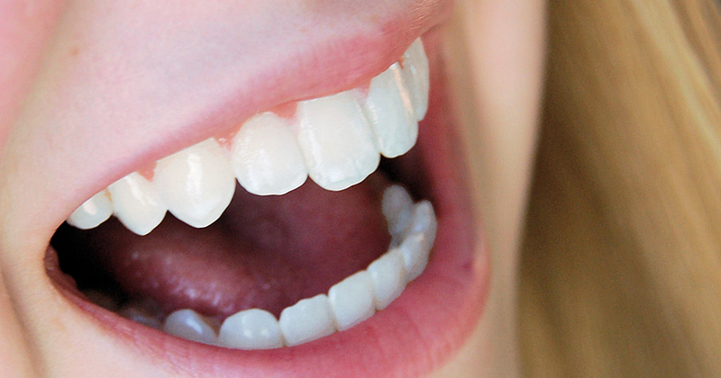 Nguyên nhân nào khiến bọc răng sứ bị hở?