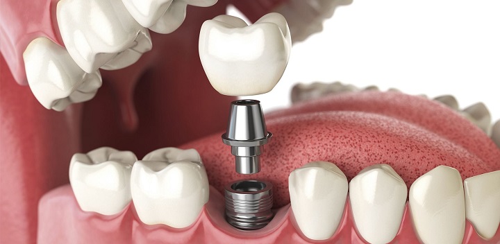 Nhổ răng bao lâu thì có thể cắm ghép implant đuợc? – Nha Khoa Hoàn Mỹ