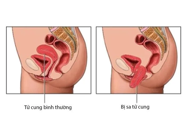 Sa tử cung: Nguyên nhân, biểu hiện & cách điều trị – vnNurse