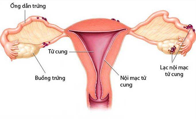 Lạc nội mạc cổ tử cung: Nguyên nhân, triệu chứng, cách điều trị – vnNurse