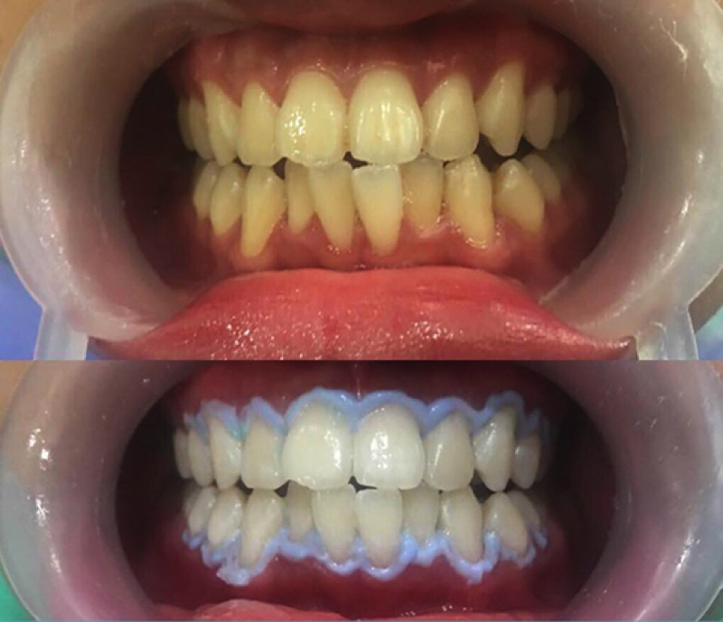 Nên chọn tẩy trắng răng tại nhà hay tẩy trắng răng tại phòng khám nha khoa? » Nhakhoahoanmyhcm
