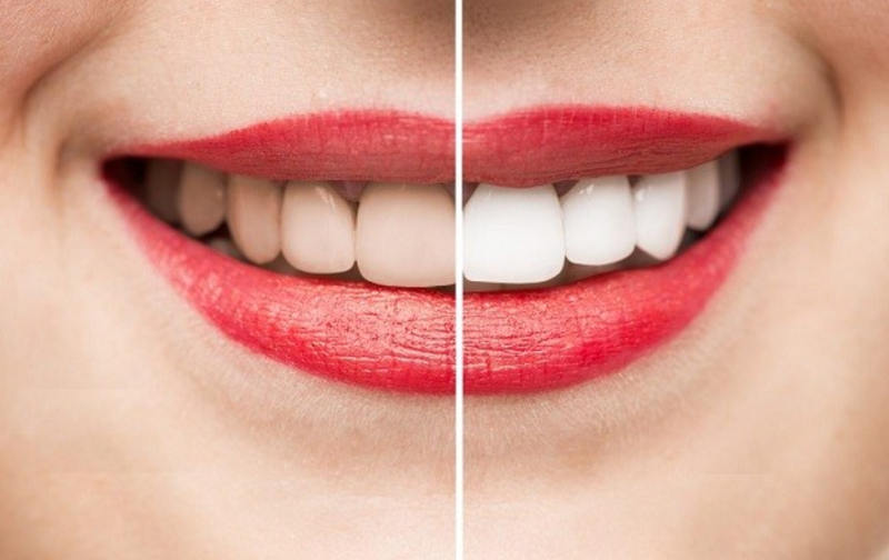 Cơ chế của quá trình tẩy trắng răng – Nha Khoa Hoàn Mỹ