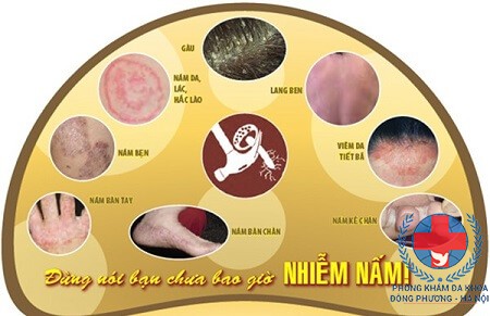 5 bệnh nấm da thường gặp và cách trị nấm da