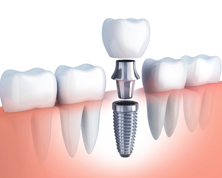 Những biến chứng có thể gặp phải khi cắm ghép implant – Nha Khoa Hoàn Mỹ