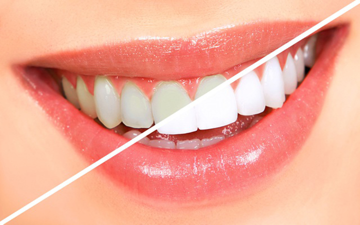 Thời gian tẩy trắng răng hợp lí là bao lâu? – Nha Khoa Hoàn Mỹ