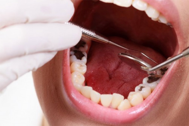 Trám răng sâu có hiệu quả hay không? – Nha Khoa Hoàn Mỹ
