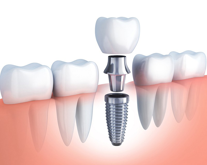 Những lí do hàng đầu để bạn lựa chọn cắm ghép implant cho răng – Nha Khoa Hoàn Mỹ