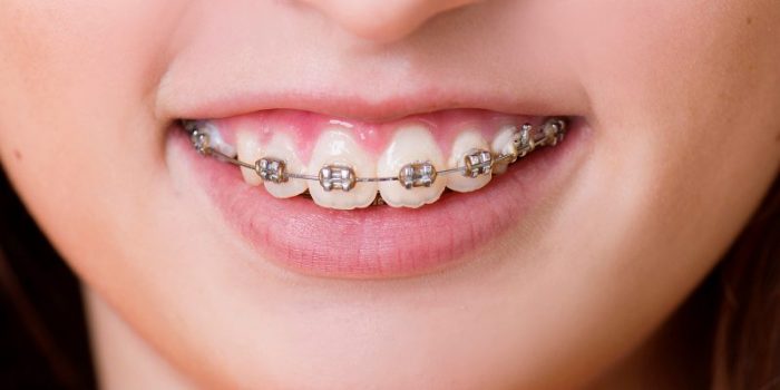 Ở độ tuổi nào thì khó thực hiện niềng răng? – Nha Khoa Hoàn Mỹ