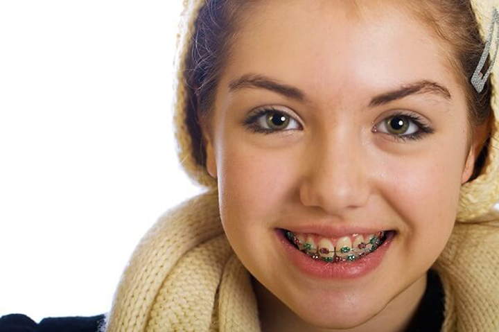 Thế nào là phương pháp chỉnh nha, niềng răng? – Nha Khoa Hoàn Mỹ