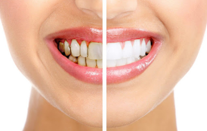 Mách bạn cách duy trì độ trắng sau tẩy răng hiệu quả – Nha Khoa Hoàn Mỹ