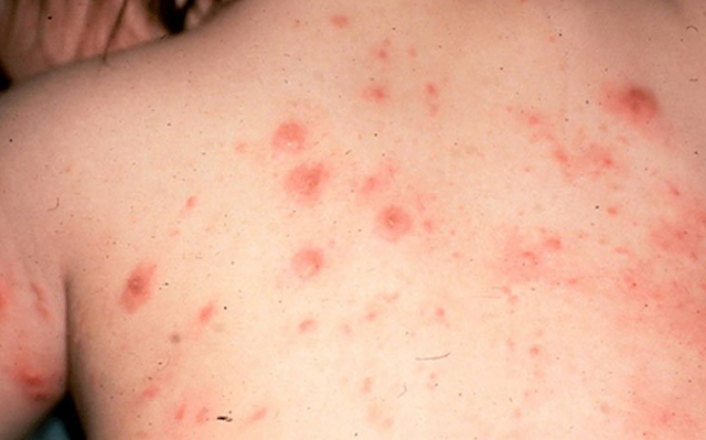 Các bệnh nhiễm nấm toàn thân thường gặp - Tư Vấn Bệnh Học
