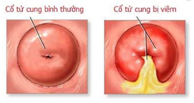 Viêm Cổ Tử Cung Nặng Có Chữa Khỏi Không? - Tư Vấn Bệnh Học