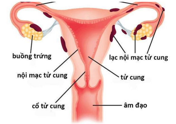 Bị lạc nội mạc tử cung nguy hiểm không? Cần làm gì? - Tư Vấn Bệnh Học