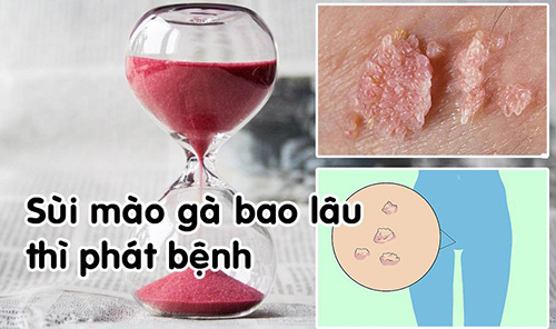 Thời gian ủ bệnh sùi mào gà có lâu không? Bác sĩ nam học chia sẻ - Phòng Khám Đa Khoa An Giang