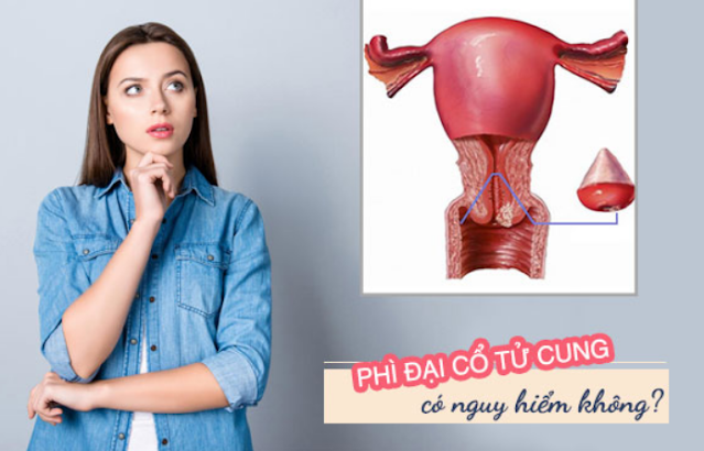 Phì đại cổ tử cung có nguy hiểm không? - Tư Vấn Bệnh Học