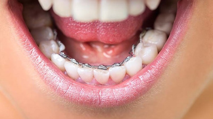 Niềng răng mặt trong có gì đặc biệt? – Nha Khoa Hoàn Mỹ