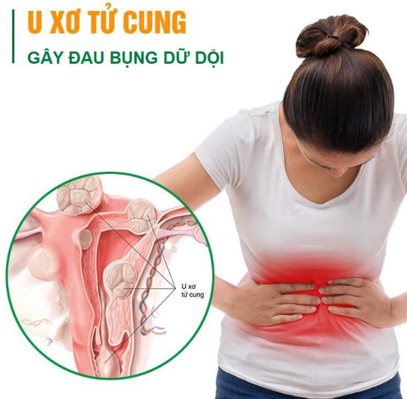 Bị U Xơ Tử Cung Kiêng Ăn Gì Để Bệnh Mau Khỏi? - Tư Vấn Bệnh Học