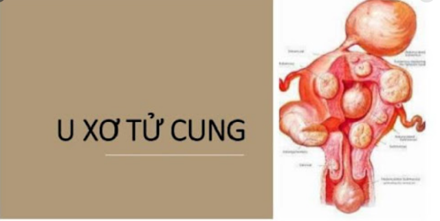 U Xơ Tử Cung Có Nguy Hiểm Không? Có Chữa Được Không? - Tư Vấn Bệnh Học