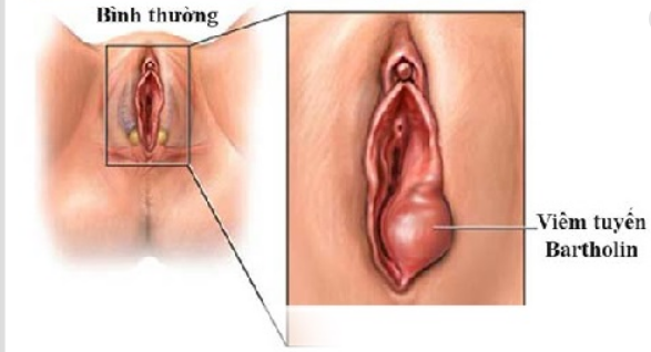 Mổ u nang tuyến Bartholin – phương pháp và chi phí mổ u nang - Tư Vấn Bệnh Học