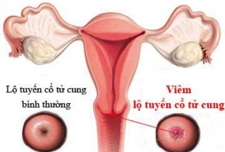 Viêm Lộ Tuyến Cổ Tử Cung Độ 3 Nên Làm Gì? - Tư Vấn Bệnh Học