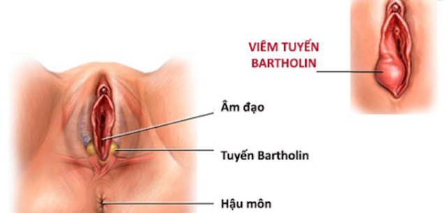 Những vấn đề cần lưu ý khi bị sưng cục ở vùng kín - Tư Vấn Bệnh Học