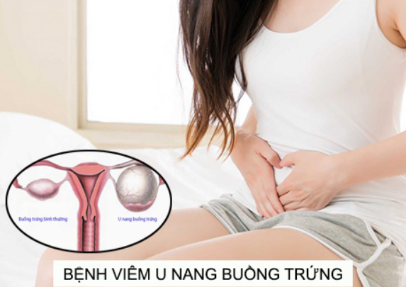 Viêm buồng trứng có gây vô sinh không? - Tư Vấn Bệnh Học