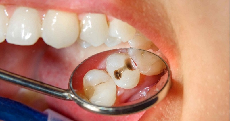 Xử lý răng khôn bị sâu hiệu quả nhất – Nha Khoa Hoàn Mỹ