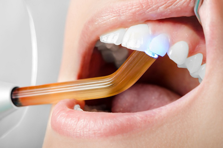 Khi nào nên thực hiện trám răng thẩm mỹ? – Nha Khoa Hoàn Mỹ
