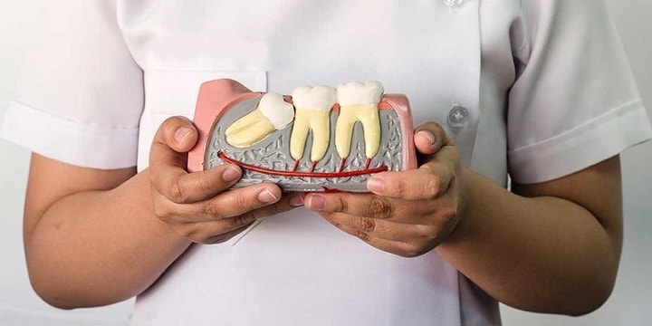 Thế nào là sót chân răng khi nhổ răng khôn?