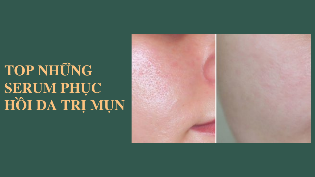 Những loại Serum phục hồi da trị mụn giúp da lên hương mua nhiều nhất