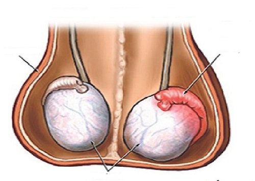 Viêm tinh hoàn phải: Nguyên nhân, dấu hiệu và cách chữa trị