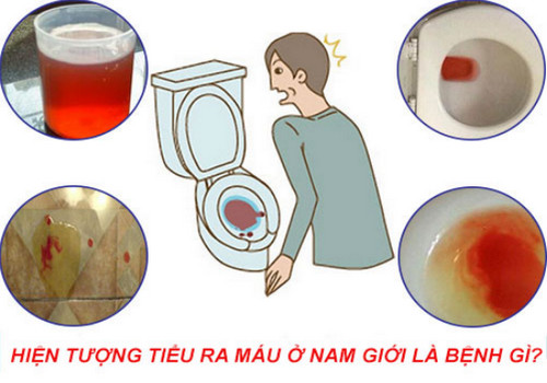 Tiểu ra máu là bệnh gì ở nam giới, chữa bệnh trong bao lâu? - Phòng Khám Đa Khoa An Giang