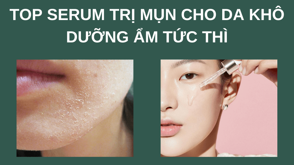 Điểm mặt top 5 serum trị mụn cho da khô dưỡng ẩm tức thì giá bình dân