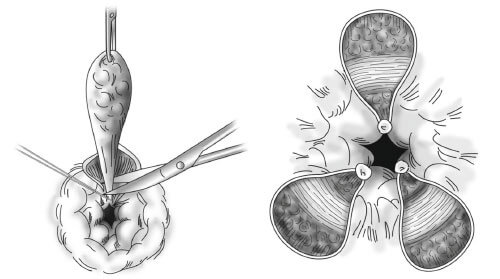 MỔ TRĨ BAO LÂU LÀNH? NÊN CẮT BẰNG PHƯƠNG PHÁP NÀO? | blogsứckhỏe