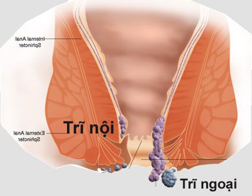 BỆNH TRĨ LÂY QUA NHỮNG ĐƯỜNG NÀO | tưvấnlàmđẹp