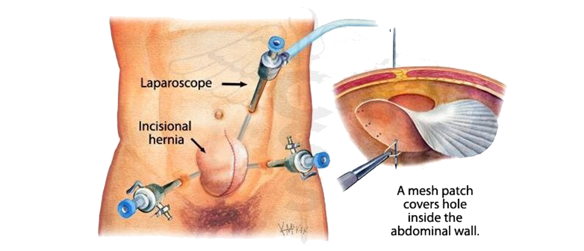 Laparoscopic Abdominal Hernia surgery or repair in Pakistan