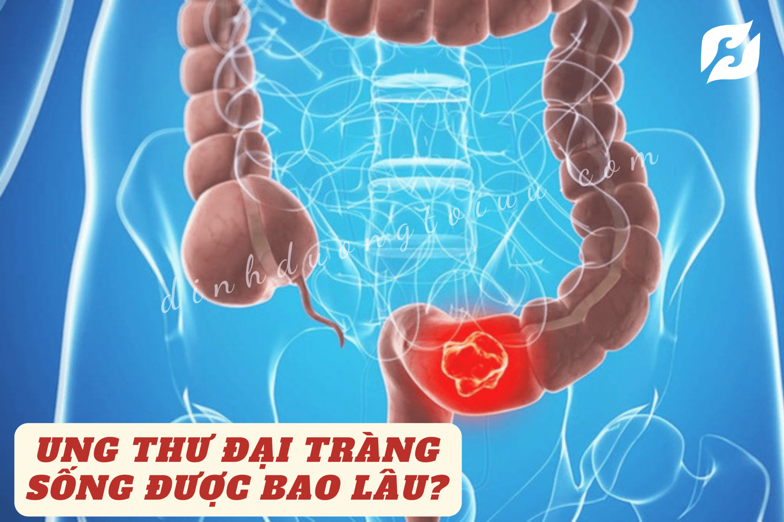 Ung thư đại tràng sống được bao lâu? - H&H Nutrition