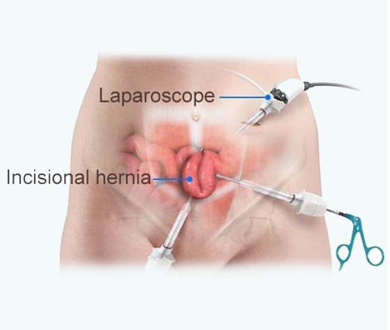 Laparoscopic Groin or Inguinal Hernia Repair in Pakistan