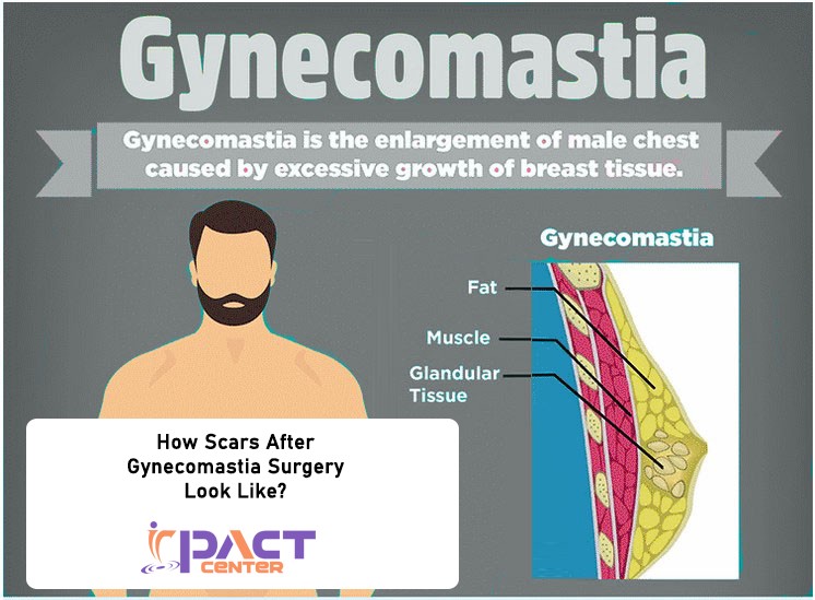 How Scars After Gynecomastia Surgery Look Like?