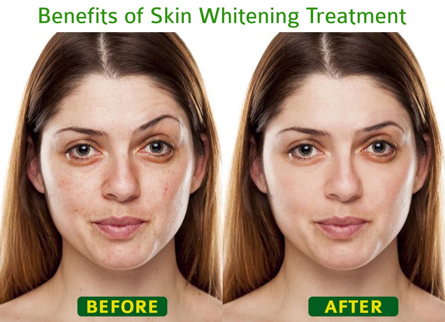 What are the health benefits of skin-whitening treatment? | by Irvincosmetics