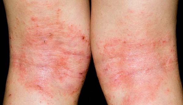 Bệnh chàm (Eczema) là gì? Nguyên nhân, triệu chứng và cách chữa