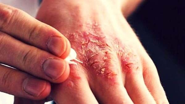 Bệnh ghẻ: Nguyên nhân, triệu chứng, con đường lây và cách điều trị