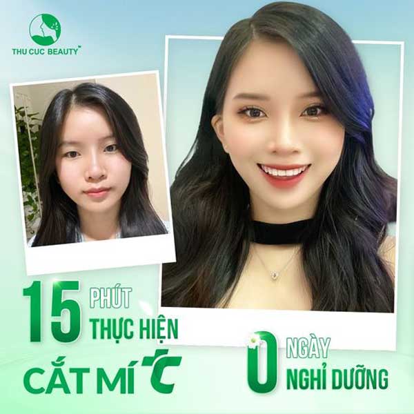 Cắt mí bao lâu thì lành? - Thẩm mỹ Thu Cúc