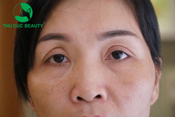 Cắt mí hỏng - Thẩm mỹ Thu Cúc