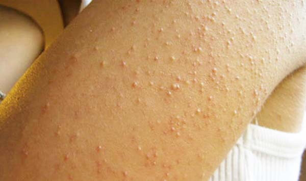Da nổi sần không ngứa - Nguyên nhân và cách khắc phục tại nhà