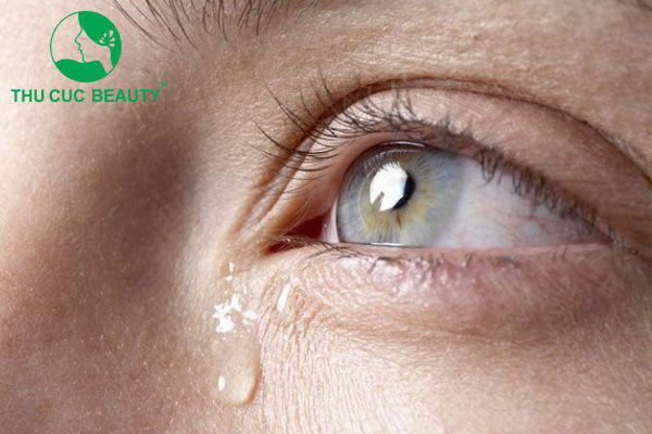 Cắt mí xong bị chảy nước mắt - Thẩm mỹ Thu Cúc