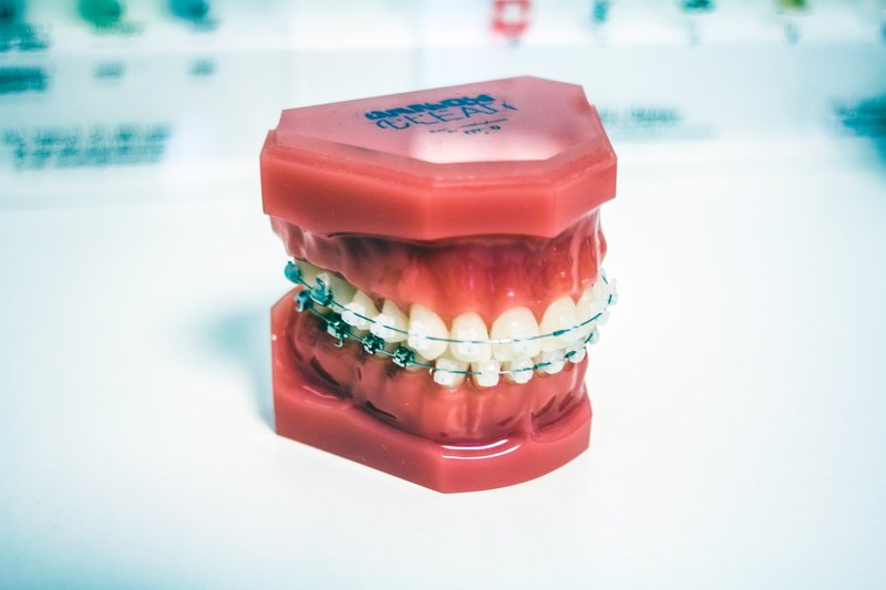 Tại sao nên niềng răng? niềng răng có tác dụng thẩm mỹ không? - Hoàn Mỹ Dental